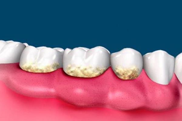 periodontia